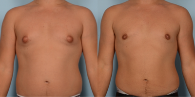 25-34 year old man treated with Gynecomastia Surgery - Gynecomastia