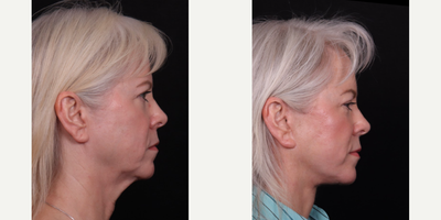 55-64 year old woman treated with Facelift, Deep Plane Facelift, Neck Lift, Eyelid Surgery, Facial Fat Transfer - Deep plane facelift, necklift, fat transfer,  blepharoplasty B&A.
