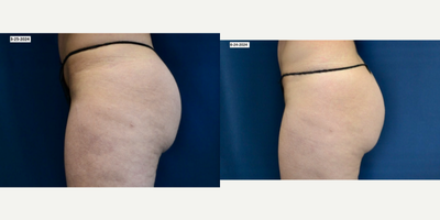 35-44 year old woman treated with Sculptra Butt Lift - Non Surgical Sculptra Butt Lift, Before March, After 3 months Post-Op