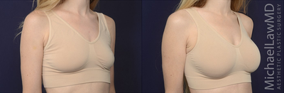 25-34 year old woman treated with Ideal Implant - Breast augmentation. Follow-up photo taken 3 months after the procedure.