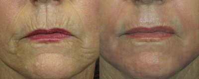 Woman treated with CO2 Laser - 	Woman treated with C02 Laser fordeep lines and wrinkles