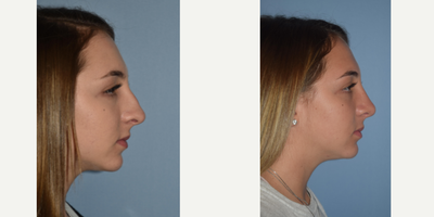18-24 year old woman treated with Rhinoplasty - 18-24 year old woman treated with Rhinoplasty shown two months post-op