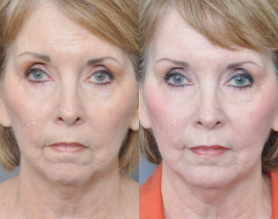 65-74 year old woman treated with Chin Implant - This patient received a chin implant for a receding chin.