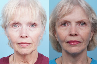 Woman treated with Facelift - Woman treated with Facelift