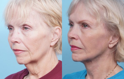 Woman treated with Facelift - Woman treated with Facelift