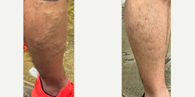45-54 year old man treated with Sclerotherapy - Patient with a large varicose vein in the leg is treated with a combinatio platform that includes microphlebectomy, sclerotherapy, and lasers.