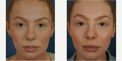 18-24 year old woman treated with Lip Augmentation - This 19-year-old patient came to our office with the goals of improving the fullness and suppleness of her lips. Patient underwent a lip augmentation with the dermal filler Restylane silk. While patient had beautiful lips before the injections, we can appreciate the improvement and beauty of this area after her procedure. This is aexample of the use of injectable fillers in a young patient to enhance their natural beauty.