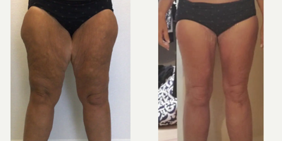 35-44 year old woman treated with Thigh Lift - Tired of feeling self-conscious about the appearance of your thighs? Dr. Meegan Gruber's Awake Thigh and Knee liposuction with Spiral Thigh Lift can help you achieve a smoother, more toned appearance. The before and after photos of Dr. Gruber's patients speak for themselves - this procedure can make a transformative difference in the contours of your thighs, giving you a newfound confidence in your body. Trust Dr. Gruber's expertise and experience to give you the results you deserve. Book your appointment today and take the first step towards the body you've always wanted!