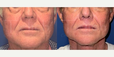65-74 year old man treated with Lip Lift, Lip Surgery - 70 year old man who underwent lip lift at the time of complete facial rejuvenation.