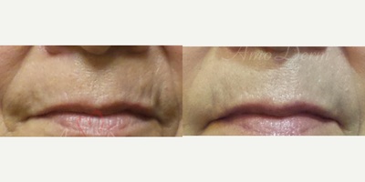 65-74 year old woman treated with Restylane Silk, Restylane, Juvederm - Treatment for smoker's lines above upper lip with filler injection (Juvederm, Belotero, Restylane Silk)