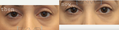 Under eye filler to reduce the appearance of eye bags - Dr. Kotlus performed a conservative cannula eye filler treatment to reduce the look of eye bags while preserving a natural, under-done look.