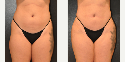 22 year old woman treated with Brazilian Butt Lift - 22 year old woman desired curvier waist and hipsPhotos on the right are 6 weeks after Liposculpting of Abdomen, Flanks, Lower Back and Fat Transfer to Hips by Dr. Steely