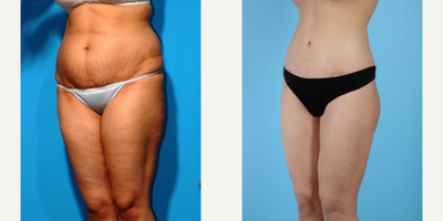 Woman treated with Body Lift - Woman treated with Body Lift