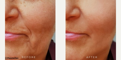 Woman treated with PlasmaPen - Plasma Pen lifts, tightens & shrinks excess skin.