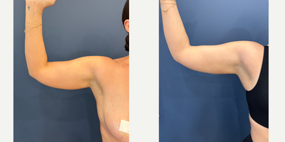 25-34 year old woman treated with Liposuction, Power-Assisted Liposuction (PAL) - This patient underwent arm liposuction to create a more defined arm contour and shape.The swelling will continue to improve.The scars will fade more over time.