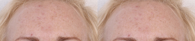 35-44 year old woman treated with Fraxel Laser - 1 month after one Fraxel treatment
