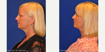 Chin Liposuction - Chin Liposuction