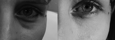 35-44 year old woman treated with Injectable Fillers - Tear trough injection with Redensity II