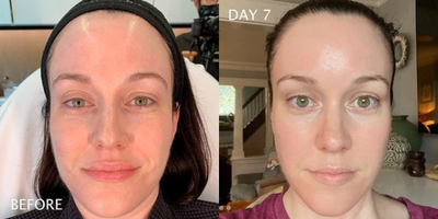 Woman treated with Moxi - Woman treated with Moxi