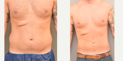 35 year old man treated with Tumescent Liposuction - SAFE liposuction abdomen and flanks