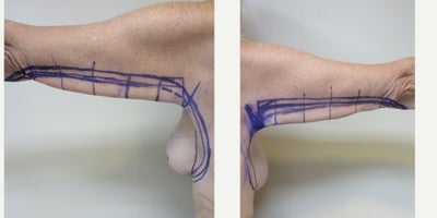 Arm Lift - Patient wanted to have the excess skin removed from her arms so she could wear short sleeve tops comfortably.