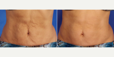 35-44 year old woman treated with Skintyte - Skintyte was used to tighten loose and sagging skin. It does this by delivering targeted infrared energy into the dermal layer of your skin. This energy creates a thermal injury, and your bodys response is to create more collagen. This additional collagen helps to restore elasticity to your skin, therefore tightening the tissue. This is a no downtime procedure, which requires on average 5 treatments spaced 4 weeks apart. This treatment is often used in conjunction with BBL above.