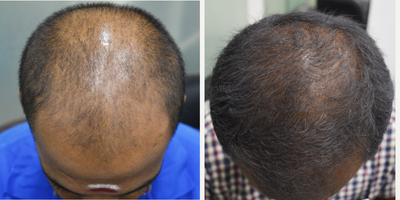 25-34 year old man treated with Derma Roller - A 28-year-old male presented with a receeding hairline. 4 sessions of Derma Roller was done for the scalp.