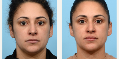 35-44 year old woman treated with Chin Liposuction, Eyelid Surgery - This 40-year-old patient explained to Dr. Wise that she felt her eyes looked heavy and older because of the excess skin that hung below her eyebrows. She also was unhappy with the stubborn fat below her chin. Dr. Wise performed both an upper blepharoplasty and submental liposuction to resolve both of these issues. Three months post-op the patient loves her results.