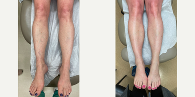 Woman treated with Sclerotherapy - A single Sclerotherapy treatment. We used hypertonic saline (high-concentration salt water) to remove those unwanted veins.