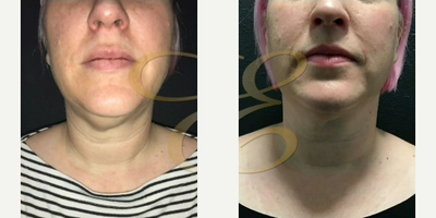 Woman treated with Chin Liposuction - Woman treated with Chin Liposuction
