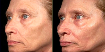 Woman treated with Pearl Laser - Pearl Laser