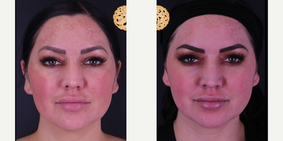 25-34 year old woman treated with Cosmelan - Cosmelan and Skin Focus - Before & After