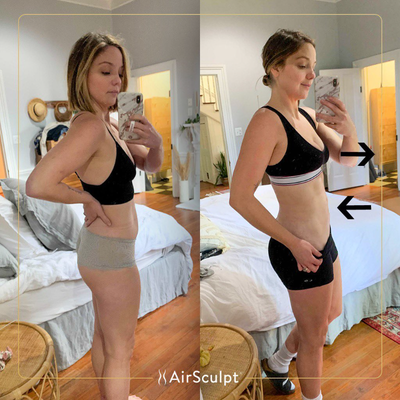 35-44 year old woman treated with AirSculpt - This patient'snewly sculpted dream body twelve months after her natural breast enhancement.