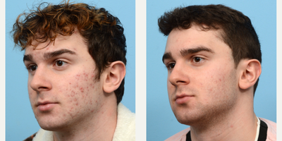 18-24 year old man treated with AviClear - This 20-year-old patient underwent 3 treatments of AviClear to treat his acne. Five months after his third session, his skin looks super clear and he is thrilled with the results!
