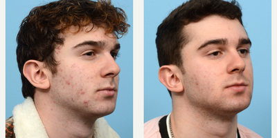 18-24 year old man treated with AviClear - This 20-year-old patient underwent 3 treatments of AviClear to treat his acne. Five months after his third session, his skin looks super clear and he is thrilled with the results!