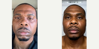25-34 year old man treated with Chin Filler, Cheek Fillers - GETTING MASCULINE IN MANHATTAN