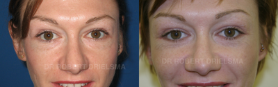 35 yo woman, cheek implants and lower lid blepharoplasty - 35 yo woman, flat cheeks, negative lower lid vector, poorly defined mid face. Corrected with insertion of expanded PTFE cheek implants via oral buccal approach, skeletally fixed. Also had lower lid blepharoplasty and mid face suspension.