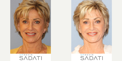 Facelift Revision Performed on a 77 Year old Orange County Woman - Revision Facelift by Orange County Facial Plastic Surgeon Dr. Kevin Sadati