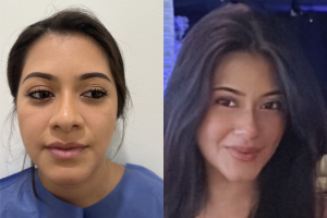Woman treated with Buccal Fat Removal - Woman treated with Buccal Fat Removal