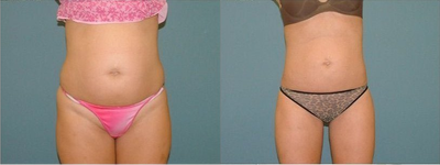 Liposuction - 
	&nbsp;This is a 26 year old female who underwent liposuction of the abdomen, hips, inner and outter thighs.&nbsp;
