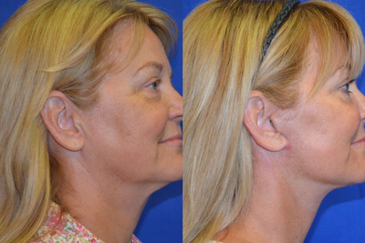 50-59 year old woman treated with Laser Resurfacing - 50-59 year old woman treated with Laser Resurfacing
