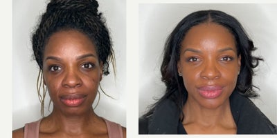 35-44 year old woman treated with Dermal Fillers, Microneedling RF - Full Face Rejuvenation With Dermal Fillers and RF MicroneedlingFull face rejuvenation can be effectively achieved using a customized combination approach. Dermal fillers are used to improve nasolabial folds, soften marionette lines, and refine chin projection and jawline for better facial balance and contour. To further enhance results, RF microneedling helps tighten the skin, improve texture, and reduce pores by stimulating collagen remodeling. This multi-modal treatment approach delivers natural-looking, long-lasting facial rejuvenation with improved skin tone, firmness, and overall harmony.