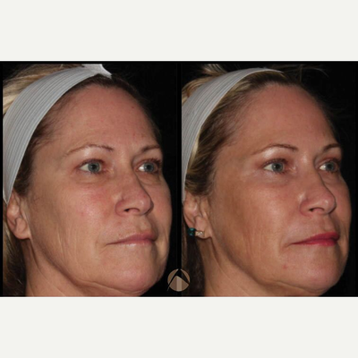 Woman treated with CO2 Laser - CO2RE, Fractional CO2 Resurfacing treatment