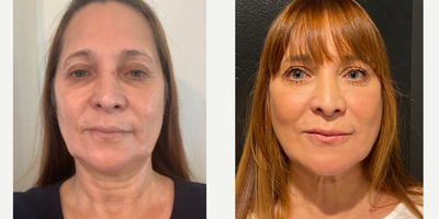 55-64 year old woman treated with TempSure Envi - After one treatment with Cyanosure TempSure Envi RF