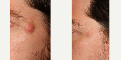 18-24 year old man treated with Mole Removal - This patient had a large cyst growing next to his eye. He wanted it removed, but with minimal scarring. Dr Rodman was able to remove it through an incision in his hairline. The scar will be barely visible in a few months and the skin over the cyst will return to normal.