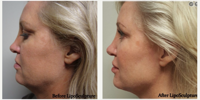 Dissolving Chin, Jowl & Facial Fat with Lipodissolve - Patient was treated with Lipodissolve / Liposculpture injections to dissolve neck and jowl fat creating a defined chin and slimmer look. Facial swelling is expected approximately 1 week as fat cells are destroyed. Fat gradually dissolves over 12 weeks. Skin tightens with collagen stimulation creating a natural, smooth and even result. Patient looks 10 years younger! Jill Porter, RN/Injector @ Innovative Directions in Health