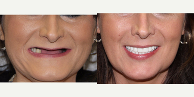 45-54 year old woman treated with All-on-4 Dental Implants - All-on-4 Dental Implants