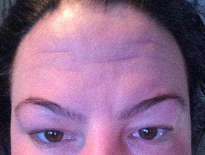 How To Get Rid Of Deep Forehead Lines Photo Doctor Answers Tips How To Get Rid Of Deep Forehead Lines Photo Doctor Answers Tips