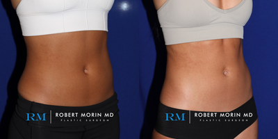 25-34 year old woman treated with Emsculpt - This 25 year old female underwent 6 treatments of Emsculpt in order to tone, sculpt and define her abs.