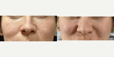 Los Angeles Fractional Laser Resurfacing for facial scars.  Before and after photos. - Our patients often tell us that they believe others see their facial scars before anything else. We change that for them.